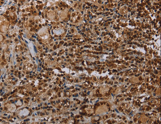 TBX5 Antibody - Immunohistochemistry of paraffin-embedded Human thyroid cancer using TBX5 Polyclonal Antibody at dilution of 1:35.
