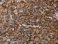 TBX5 Antibody - Immunohistochemistry of paraffin-embedded Human thyroid cancer using TBX5 Polyclonal Antibody at dilution of 1:35.