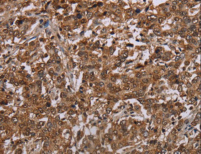 TBX5 Antibody - Immunohistochemistry of paraffin-embedded Human liver cancer using TBX5 Polyclonal Antibody at dilution of 1:35.