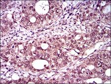 TBXT / T / Brachyury Antibody - IHC of paraffin-embedded cervical cancer tissues using T mouse monoclonal antibody with DAB staining.