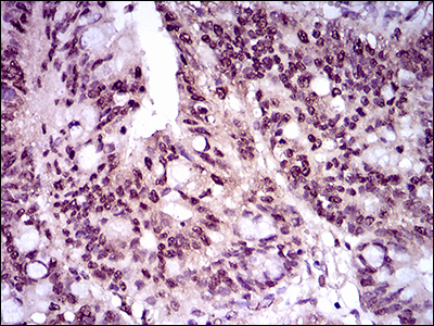 TBXT / T / Brachyury Antibody - IHC of paraffin-embedded rectum cancer tissues using T mouse monoclonal antibody with DAB staining.