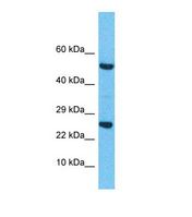 TC21 / RRAS2 Antibody - Western blot of Human Esophagus Tumor. RRAS2 antibody dilution 1.0 ug/ml.  This image was taken for the unconjugated form of this product. Other forms have not been tested.