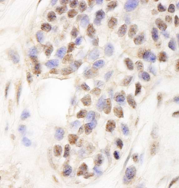 TCAB1 / WDR79 Antibody - Detection of Human WDR79 by Immunohistochemistry. Sample: FFPE section of human breast carcinoma. Antibody: Affinity purified rabbit anti-WDR79 used at a dilution of 1:200 (1 ug/ml). Detection: DAB.