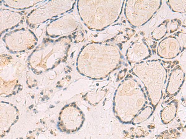 TCAP / Telethonin Antibody - Immunohistochemistry of paraffin-embedded Human thyroid cancer tissue  using TCAP Polyclonal Antibody at dilution of 1:55(×200)
