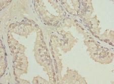 TCBE / KCS / HRD Antibody - Immunohistochemistry of paraffin-embedded human prostate cancer at dilution 1:100