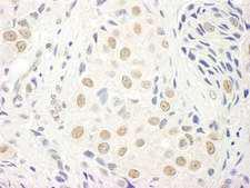 TCEA1 / TFIIS Antibody - Detection of Human TFIIS by Immunohistochemistry. Sample: FFPE section of human breast carcinoma. Antibody: Affinity purified rabbit anti-TFIIS used at a dilution of 1:5000 (0.2 ug/ml). Detection: DAB.