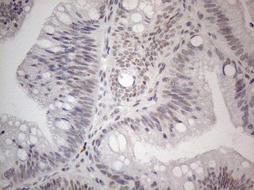 TCEAL1 Antibody - Immunohistochemical staining of paraffin-embedded Carcinoma of Human pancreas tissue using anti-TCEAL1 mouse monoclonal antibody. (Heat-induced epitope retrieval by 1mM EDTA in 10mM Tris buffer. (pH8.5) at 120°C for 3 min. (1:150)