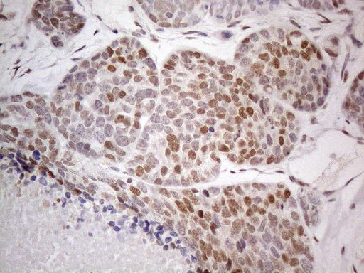 TCEAL1 Antibody - Immunohistochemical staining of paraffin-embedded Adenocarcinoma of Human endometrium tissue using anti-TCEAL1 mouse monoclonal antibody. (Heat-induced epitope retrieval by 1mM EDTA in 10mM Tris buffer. (pH8.5) at 120°C for 3 min. (1:150)