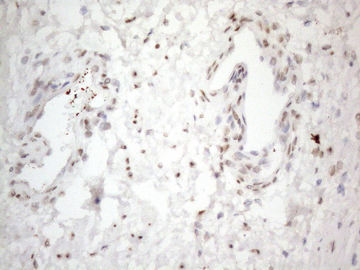 TCEAL1 Antibody - Immunohistochemical staining of paraffin-embedded Carcinoma of Human prostate tissue using anti-TCEAL1 mouse monoclonal antibody. (Heat-induced epitope retrieval by 1mM EDTA in 10mM Tris buffer. (pH8.5) at 120°C for 3 min. (1:150)