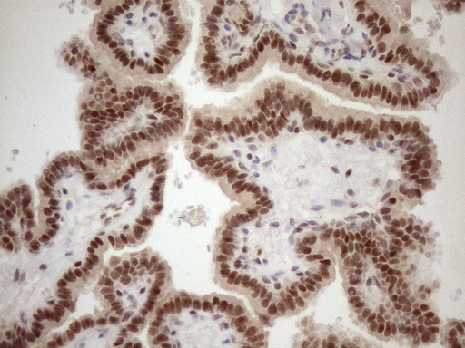 TCEAL1 Antibody - Immunohistochemical staining of paraffin-embedded Carcinoma of Human thyroid tissue using anti-TCEAL1 mouse monoclonal antibody. (Heat-induced epitope retrieval by 1mM EDTA in 10mM Tris buffer. (pH8.5) at 120 oC for 3 min. (1:150)