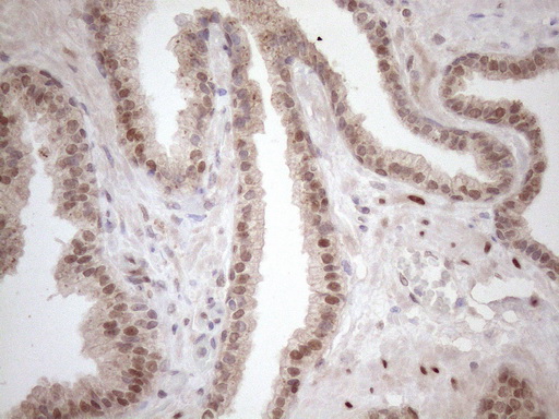 TCEAL1 Antibody - Immunohistochemical staining of paraffin-embedded Carcinoma of Human prostate tissue using anti-TCEAL1 mouse monoclonal antibody. (Heat-induced epitope retrieval by 1mM EDTA in 10mM Tris buffer. (pH8.5) at 120 oC for 3 min. (1:150)