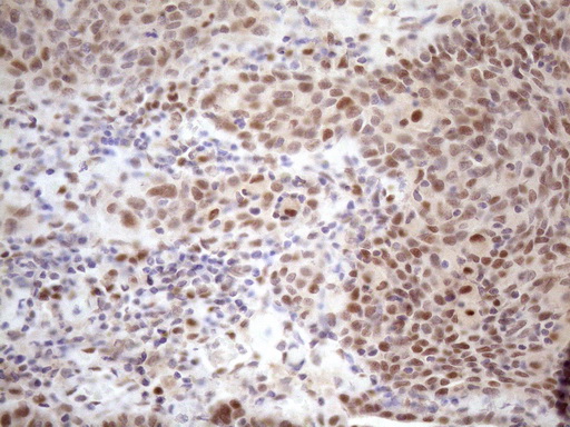 TCEAL1 Antibody - Immunohistochemical staining of paraffin-embedded Carcinoma of Human bladder tissue using anti-TCEAL1 mouse monoclonal antibody. (Heat-induced epitope retrieval by 1mM EDTA in 10mM Tris buffer. (pH8.5) at 120 oC for 3 min. (1:150)
