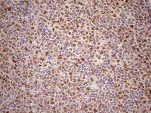 TCEAL1 Antibody - Immunohistochemical staining of paraffin-embedded Human lymphoma tissue using anti-TCEAL1 mouse monoclonal antibody. (Heat-induced epitope retrieval by 1mM EDTA in 10mM Tris buffer. (pH8.5) at 120 oC for 3 min. (1:150)