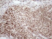 TCEAL1 Antibody - Immunohistochemical staining of paraffin-embedded Adenocarcinoma of Human endometrium tissue using anti-TCEAL1 mouse monoclonal antibody. (Heat-induced epitope retrieval by 1mM EDTA in 10mM Tris buffer. (pH8.5) at 120 oC for 3 min. (1:150)