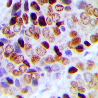 TCEAL1 Antibody - Immunohistochemical analysis of TCEAL1 staining in human prostate cancer formalin fixed paraffin embedded tissue section. The section was pre-treated using heat mediated antigen retrieval with sodium citrate buffer (pH 6.0). The section was then incubated with the antibody at room temperature and detected with HRP and DAB as chromogen. The section was then counterstained with hematoxylin and mounted with DPX.