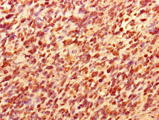 TCEAL8 Antibody - Immunohistochemistry of paraffin-embedded human glioma using TCEAL8 Antibody at dilution of 1:100