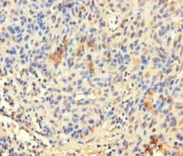 TCEANC2 Antibody - Immunohistochemistry of paraffin-embedded human bladder cancer using TCEANC2 Antibody at dilution of 1:100