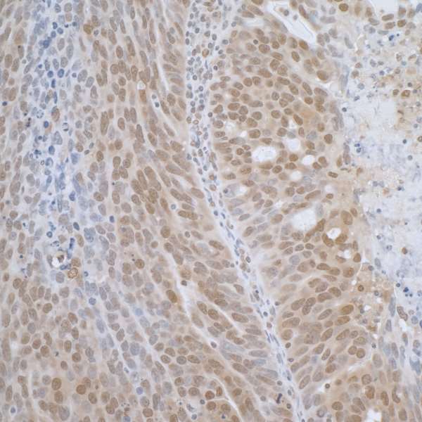 TCEB1 / Elongin C Antibody - Detection of human TCEB1 by immunohistochemistry. Sample: FFPE section of human ovarian carcinoma. Antibody: Affinity purified rabbit anti-TCEB1 used at a dilution of 1:1,000 (1µg/ml). Detection: DAB. Counterstain: IHC Hematoxylin (blue).
