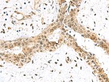 TCEB1 / Elongin C Antibody - Immunohistochemistry of paraffin-embedded Human breast cancer tissue  using ELOC Polyclonal Antibody at dilution of 1:55(×200)