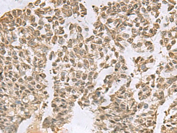 TCEB1 / Elongin C Antibody - Immunohistochemistry of paraffin-embedded Human ovarian cancer tissue  using ELOC Polyclonal Antibody at dilution of 1:55(×200)