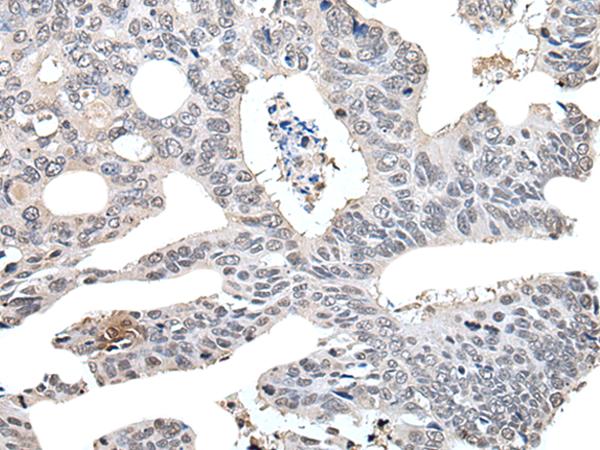 TCEB2 / Elongin B Antibody - Immunohistochemistry of paraffin-embedded Human colorectal cancer tissue  using TCEB2 Polyclonal Antibody at dilution of 1:40(×200)