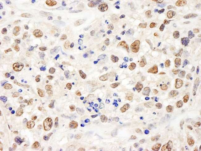 TCEB3 / Elongin A Antibody - Detection of Human TCEB3 by Immunohistochemistry. Sample: FFPE section of human metastatic lymph node. Antibody: Affinity purified rabbit anti-TCEB3 used at a dilution of 1:1000 (1 ug/ml). Detection: DAB.