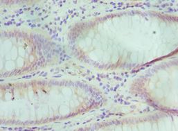 TCEB3 / Elongin A Antibody - Immunohistochemistry of paraffin-embedded human colon cancer using antibody at 1:100 dilution.