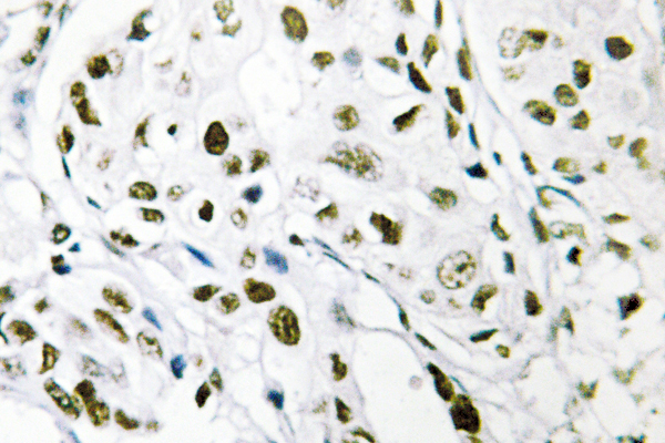 TCEB3 / Elongin A Antibody - IHC of Elongin A1 (R129) pAb in paraffin-embedded human breast carcinoma tissue.