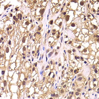 TCEB3 / Elongin A Antibody - Immunohistochemistry of paraffin-embedded human kidney cancer tissue.