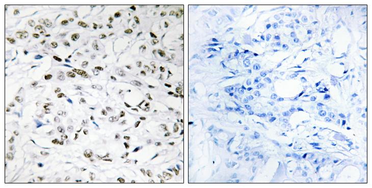 TCEB3 / Elongin A Antibody - Peptide - + Immunohistochemistry analysis of paraffin-embedded human breast carcinoma tissue using ELOA1 antibody.