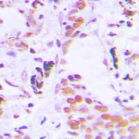 TCEB3C / Elongin A3 Antibody - Immunohistochemical analysis of TCEB3C staining in human breast cancer formalin fixed paraffin embedded tissue section. The section was pre-treated using heat mediated antigen retrieval with sodium citrate buffer (pH 6.0). The section was then incubated with the antibody at room temperature and detected using an HRP conjugated compact polymer system. DAB was used as the chromogen. The section was then counterstained with hematoxylin and mounted with DPX.