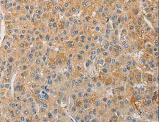 TCF11 / NFE2L1 Antibody - Immunohistochemistry of paraffin-embedded Human liver cancer using NFE2L1 Polyclonal Antibody at dilution of 1:30.