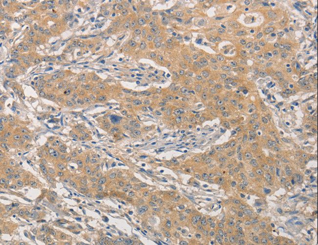 TCF11 / NFE2L1 Antibody - Immunohistochemistry of paraffin-embedded Human gastric cancer using NFE2L1 Polyclonal Antibody at dilution of 1:30.