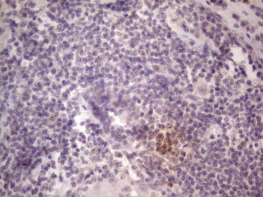 TCF12 / HEB Antibody - Immunohistochemical staining of paraffin-embedded Carcinoma of Human lung tissue using anti-TCF12 mouse monoclonal antibody. (Heat-induced epitope retrieval by 1 mM EDTA in 10mM Tris, pH8.5, 120C for 3min,