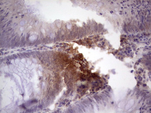 TCF12 / HEB Antibody - Immunohistochemical staining of paraffin-embedded Adenocarcinoma of Human colon tissue using anti-TCF12 mouse monoclonal antibody. (Heat-induced epitope retrieval by 1 mM EDTA in 10mM Tris, pH8.5, 120C for 3min,