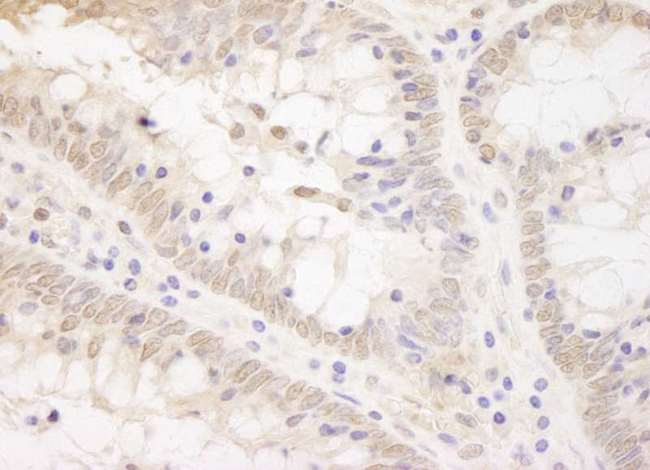 TCF12 / HEB Antibody - Detection of Human TCF12 by Immunohistochemistry. Sample: FFPE section of human colon carcinoma. Antibody: Affinity purified rabbit anti-TCF12 used at a dilution of 1:250. Epitope Retrieval Buffer-High pH (IHC-101J) was substituted for Epitope Retrieval Buffer-Reduced pH.