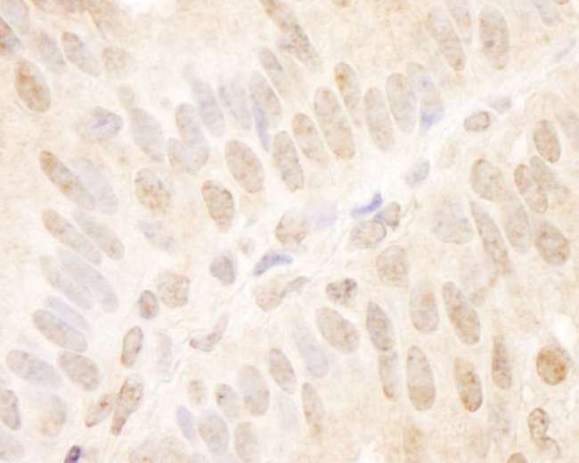 TCF12 / HEB Antibody - Detection of Human TCF12 by Immunohistochemistry. Sample: FFPE section of human breast carcinoma. Antibody: Affinity purified rabbit anti-TCF12 used at a dilution of 1:1000 (1 ug/ml). Detection: DAB.