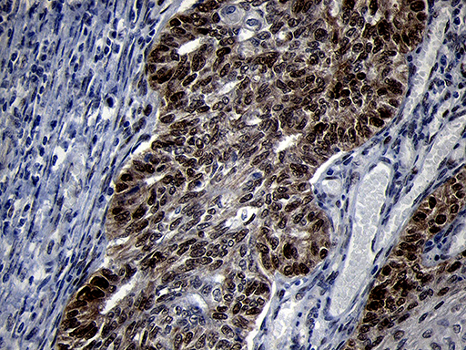 TCF12 / HEB Antibody - Immunohistochemical staining of paraffin-embedded Adenocarcinoma of Human endometrium tissue using anti-TCF12 mouse monoclonal antibody. (Heat-induced epitope retrieval by 1mM EDTA in 10mM Tris buffer. (pH8.5) at 120°C for 3 min. (1:1000)