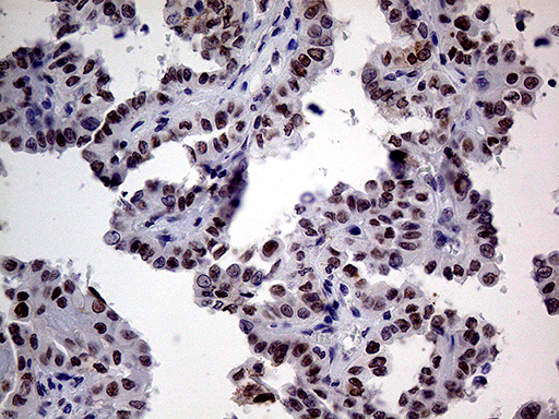 TCF12 / HEB Antibody - Immunohistochemical staining of paraffin-embedded Carcinoma of Human thyroid tissue using anti-TCF12 mouse monoclonal antibody. (Heat-induced epitope retrieval by 1mM EDTA in 10mM Tris buffer. (pH8.5) at 120°C for 3 min. (1:500)