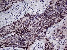 TCF12 / HEB Antibody - Immunohistochemical staining of paraffin-embedded Carcinoma of Human lung tissue using anti-TCF12 mouse monoclonal antibody. (Heat-induced epitope retrieval by 1mM EDTA in 10mM Tris buffer. (pH8.5) at 120°C for 3 min. (1:1000)