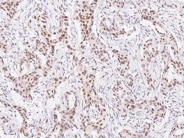 TCF12 / HEB Antibody - Immunochemical staining of human TCF12 in human breast carcinoma with rabbit polyclonal antibody at 1:300 dilution, formalin-fixed paraffin embedded sections.