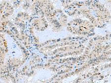TCF19 / TCF-19 Antibody - Immunohistochemistry of paraffin-embedded Human thyroid cancer tissue  using TCF19 Polyclonal Antibody at dilution of 1:60(×200)