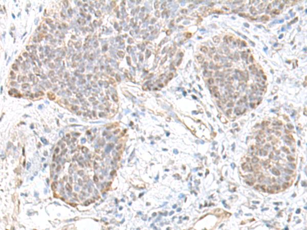TCF25 Antibody - Immunohistochemistry of paraffin-embedded Human esophagus cancer tissue  using TCF25 Polyclonal Antibody at dilution of 1:35(×200)