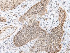 TCF25 Antibody - Immunohistochemistry of paraffin-embedded Human esophagus cancer tissue  using TCF25 Polyclonal Antibody at dilution of 1:40(×200)