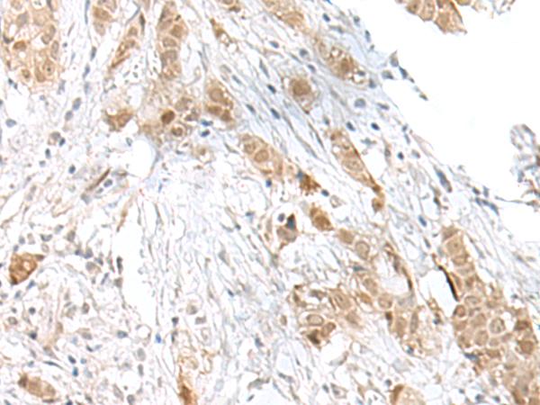 TCF25 Antibody - Immunohistochemistry of paraffin-embedded Human breast cancer tissue  using TCF25 Polyclonal Antibody at dilution of 1:40(×200)