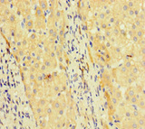TCF4 Antibody - Immunohistochemistry of paraffin-embedded human liver cancer at dilution of 1:100
