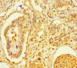 TCF4 Antibody - Immunohistochemistry of paraffin-embedded human pancreatic cancer at dilution of 1:100