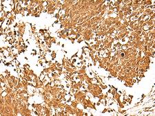 TCF7 Antibody - Immunohistochemistry of paraffin-embedded Human lung cancer tissue  using TCF7 Polyclonal Antibody at dilution of 1:30(×200)