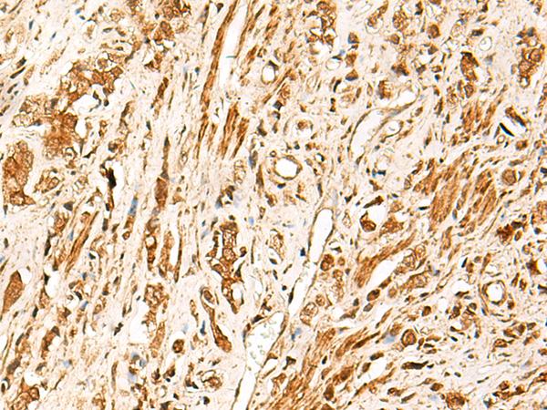 TCF7 Antibody - Immunohistochemistry of paraffin-embedded Human prost ate cancer tissue  using TCF7 Polyclonal Antibody at dilution of 1:30(×200)