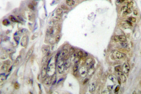TCF7 Antibody - IHC of TCF-1 (F26) pAb in paraffin-embedded human colon carcinoma tissue.